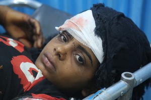 在也門荷台達的一所醫院，一名受傷的女孩正在接受治療。她和弟弟、叔叔一起受傷，當時一家人正試圖搬到遠離戰鬥的地區。（圖源：聯合國）