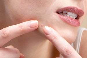 用手擠青春痘是錯誤行為要注意