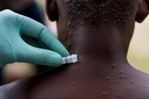  美國發現1名從尼日利亞返美的猴痘病毒病例。 （《紐約時報》報導截圖）