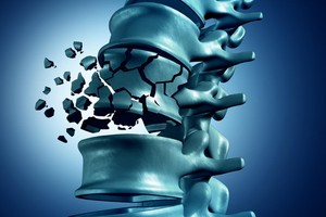 9旬老翁壓迫性骨折，補骨水泥仍痛不欲生！