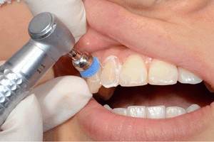 洗牙會讓牙縫變大？