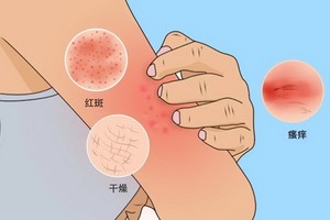 皮膚感染嚴重時或危及生命
