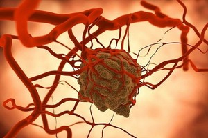 結節、息肉、囊腫 哪個才是癌症先兆？