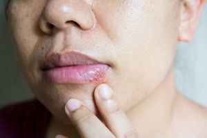 嘴唇長小水泡是唇皰疹還是口角炎？