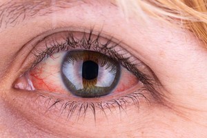 眼科醫親授3招預防急性結膜炎