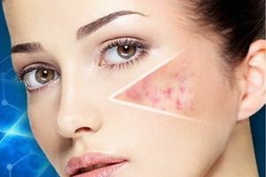 不同類型玫瑰痤瘡症狀不一樣！