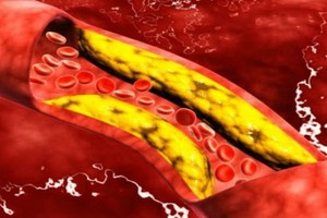 血管裡斑塊能溶解或被吸出來？