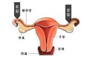 導致附件炎５大元兇要謹防！