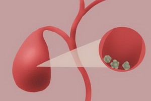 膽結石能不能“保膽取石”？