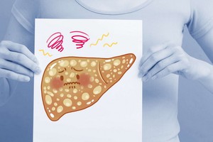 肝臟震波檢查及早揪出肝纖維化