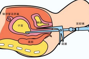 宮腔鏡術後怎樣調養