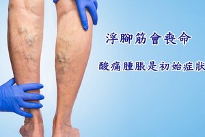 小腿浮青筋像“蚯蚓”靜脈曲張會要命！