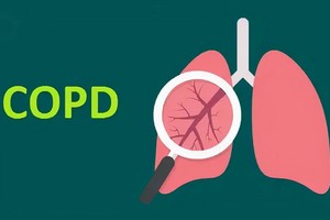 慢阻肺專盯５類人
