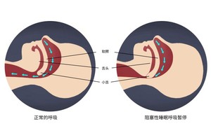 如何治療阻塞性睡眠呼吸暫停綜合症