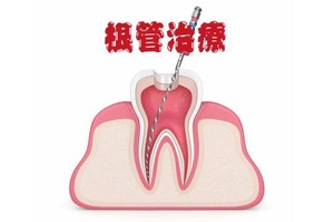 做完根管治療後須注意問題