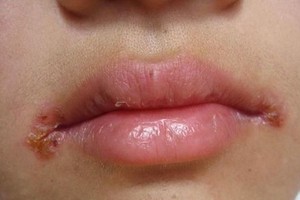 唇皰疹不是口角炎