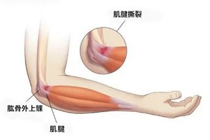 手肘痛就是網球肘？