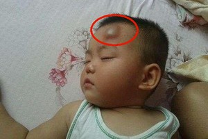 跌倒頭上磕出大包？專家：４件事不能做