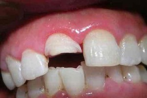孩子门牙磕掉了一块可不管吗？