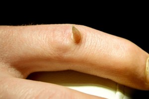 人的皮肤竟然也会长「角」