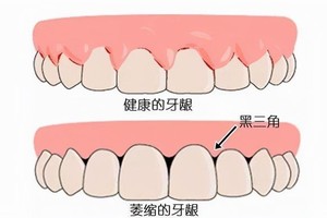 别再因牙龈萎缩烦恼