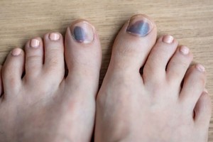 医生提醒甲下出血别轻忽