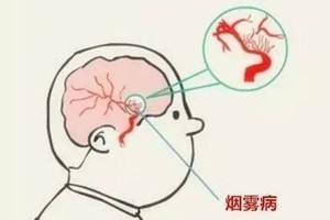 年轻人头晕=没休息好？