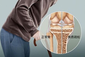 别忘预防骨质疏松