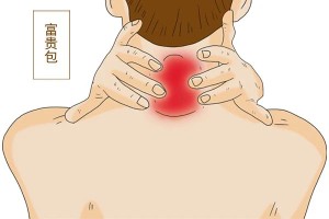 “富贵包”或是颈椎病前兆