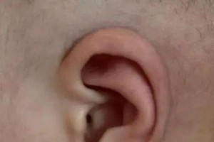 新生宝宝耳朵小、耳朵皱或是耳廓畸形
