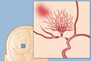 头痛、头晕、记忆力下降 当心这种病作祟