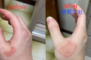 皮疹愈来愈大片、变薄表示病症开始好转。