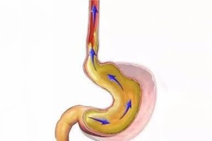 灼烧年轻人的胃病