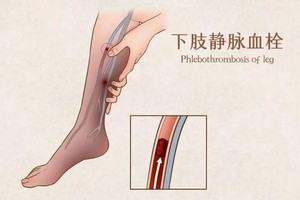 床上多躺了几天，差点被静脉血栓要了命