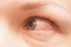 新冠为啥会连累眼睛？