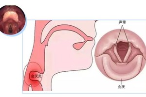 喉痛、呼吸困难时当心“夺命凶手”会是厌炎