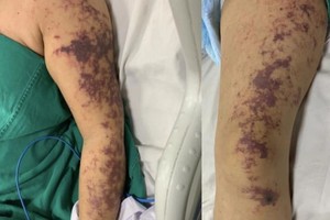 感染猪链球菌引起的皮肤临床症状。（图：院方提供）