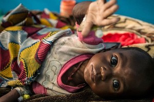 一名7个月大的婴儿因严重急性营养不良在马里通布图的一家地区医院接受治疗。（图：UNICEF）