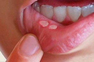 轻忽口腔溃疡 细菌入侵心脏破洞