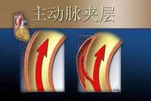 该怎防比心梗还凶险的主动脉夹层？