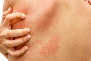 压力、运动竟会诱发荨麻疹