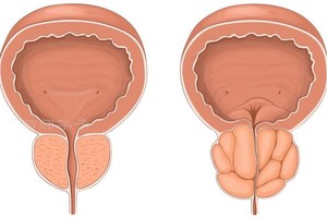 学会４招前列腺更健康