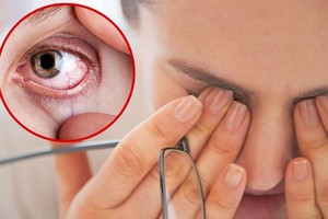 她眼冒「12颗珍珠」竟是干眼症！