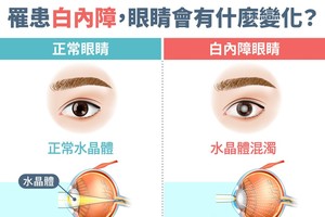 白内障前兆有哪些？