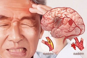 学会快速识别脑卒中，抓住黄金抢救时间
