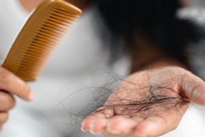 女生也会雄性秃？ “这形状”秃发要注意！