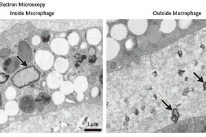 电镜照片显示，患者颈动脉斑块巨噬细胞中可见锯齿状异物颗粒（箭头）。（图：论文）