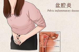 有盆腔积液就意味着有盆腔炎吗？