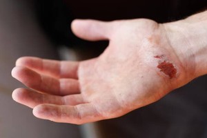 医师表示，若皮肤有伤口而感染噬肉菌，会导致坏死性肌肉发炎；若进入到血液，死亡风险恐增加。（示意图：Freepik）