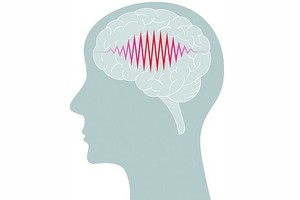 人为什么会得「癫痫」？